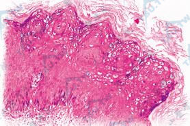 扁平疣　角化过度，棘层肥厚。棘层上部、颗粒层内有许多空泡化细胞（HE染色×100）