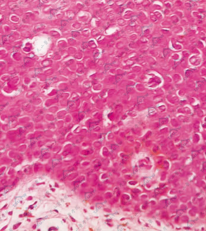 表皮细胞极向紊乱，见细胞分裂象及角化不良细胞（HE染色×400）