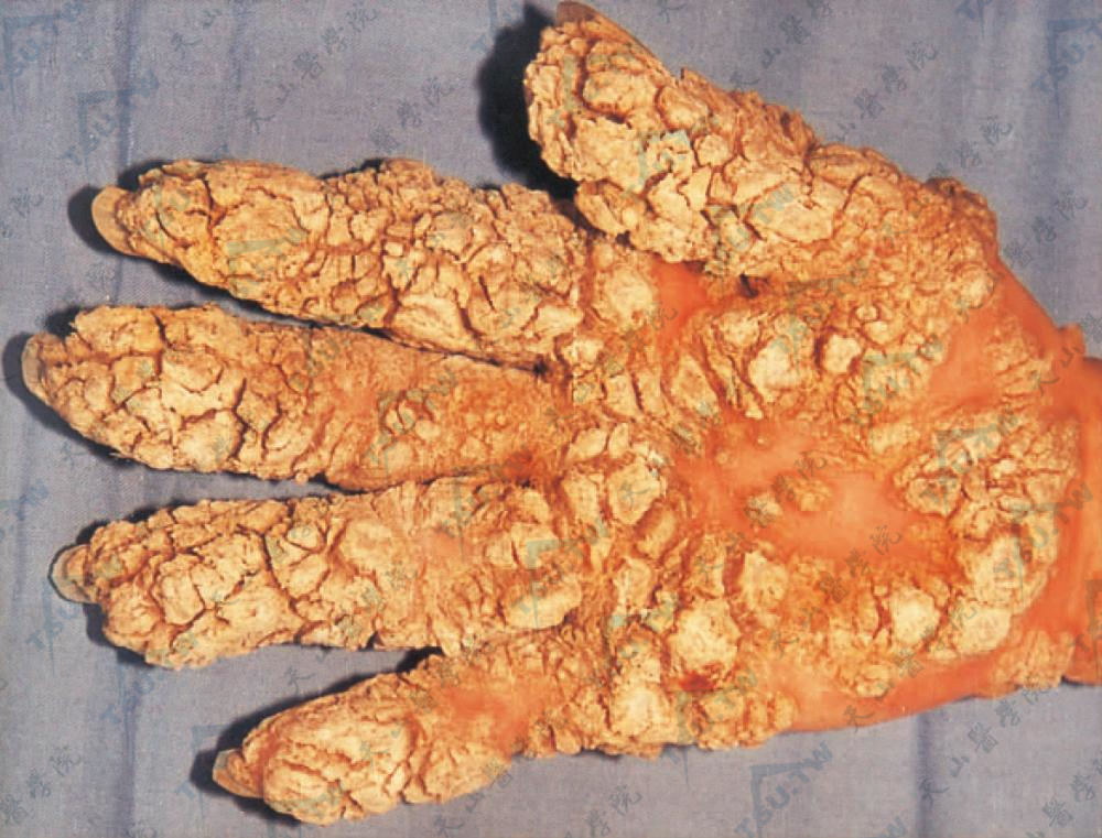 疣状表皮发育不良少见特殊型，除见典型皮疹外，手掌呈大片角质增殖，疣状皮损