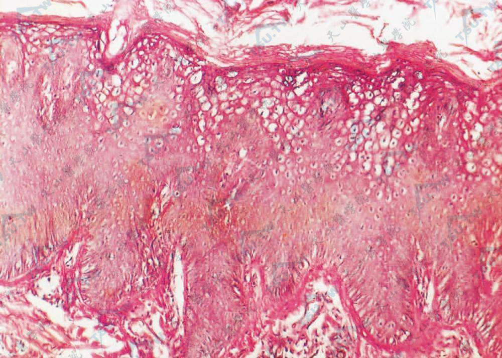 除角化过度、棘层肥厚外，棘层上部、颗粒层内见空泡化细胞（HE染色×100）