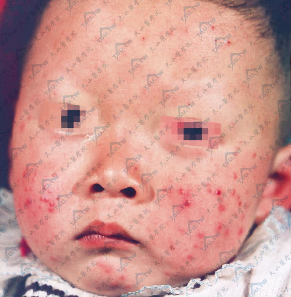 额、面颊及颏部针头大至绿豆大扁平充实性丘疹，暗红、紫红或淡褐色
