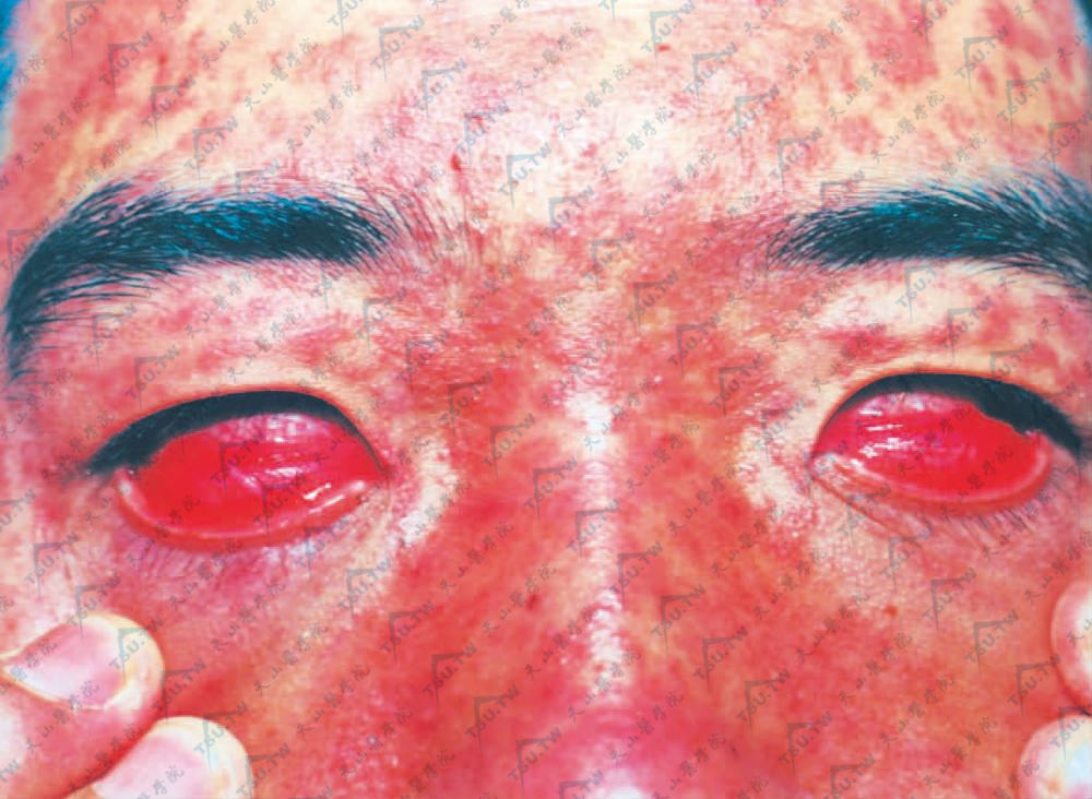 麻疹：眼结膜充血、畏光