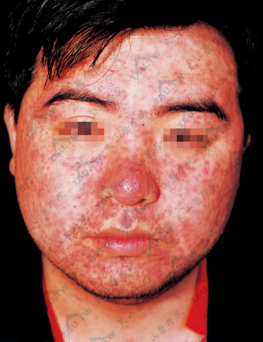 麻疹：发生在面部皮疹呈玫瑰色斑丘疹，疹密集，但疹间皮肤正常