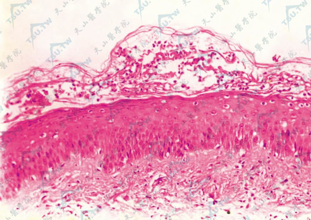 角质层下脓疱，疱腔内炎细胞及纤维素样渗出物（HE染色×100）