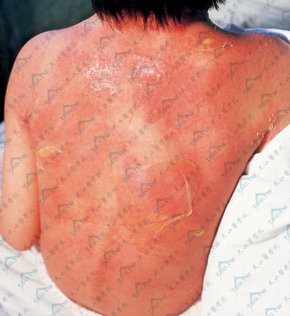 背部弥漫性红斑，红斑基础上有松弛性脓疮，表皮浅层起皱，大片剥脱，有黄色脓液
