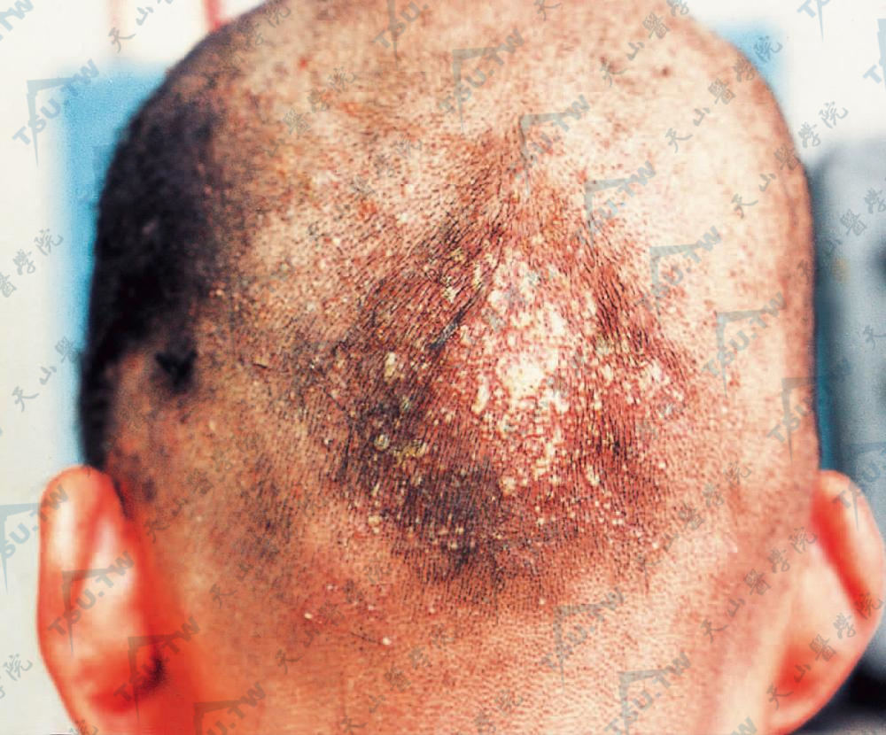 枕后部多数毛发皮脂腺开口部发生浅表圆形小脓疱，米粒大至绿豆大，周围有红晕