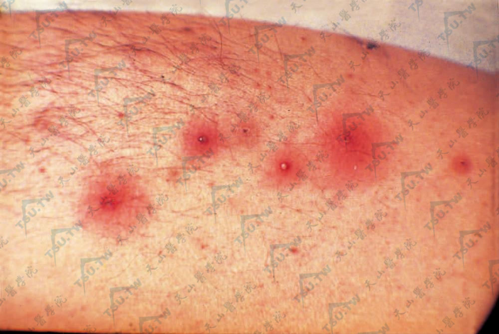 在毛囊开口处发生红色丘疹，顶端有小脓疱，四周绕以明显红晕