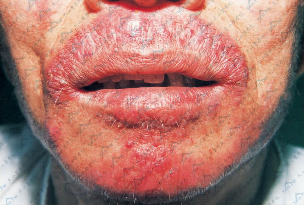 上唇上方及下颌部毛囊性丘疹或脓疱，脓疱破后干燥结痂，簇集成浸润性斑块。周围有散在毛囊性丘疹或脓疱