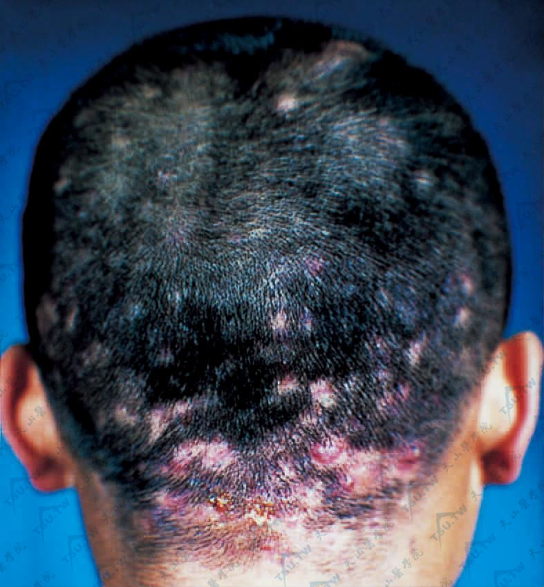 秃发性毛囊炎（Folliculitis Decalvans）