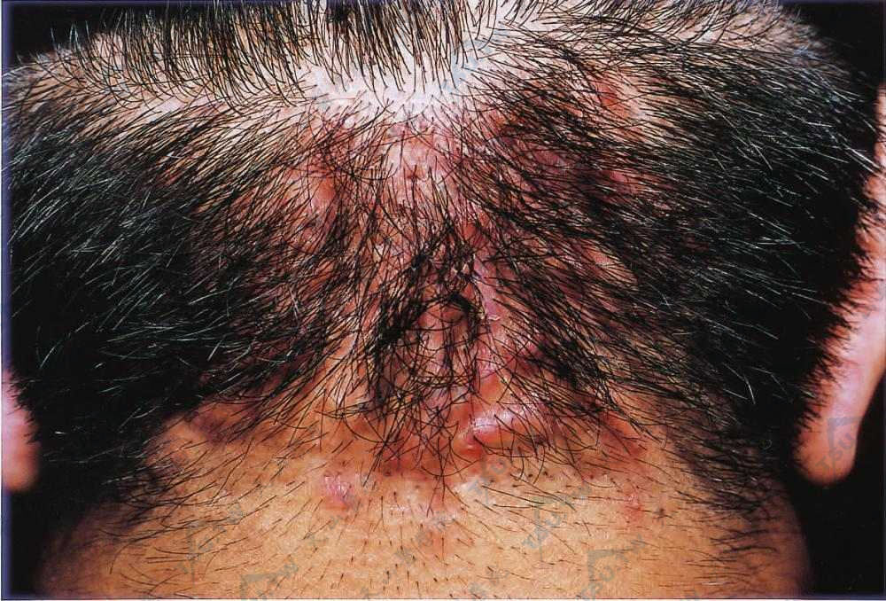 项部发缘慢性毛囊炎性丘疹和脓疱互相融合，形成不规则瘢痕硬结，有些地方有小的凹陷，可见有束状毛发穿出，脓液很少