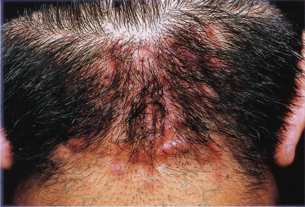 项部瘢痕疙瘩性毛囊炎（Folliculitis Keloidalis Nuchae）