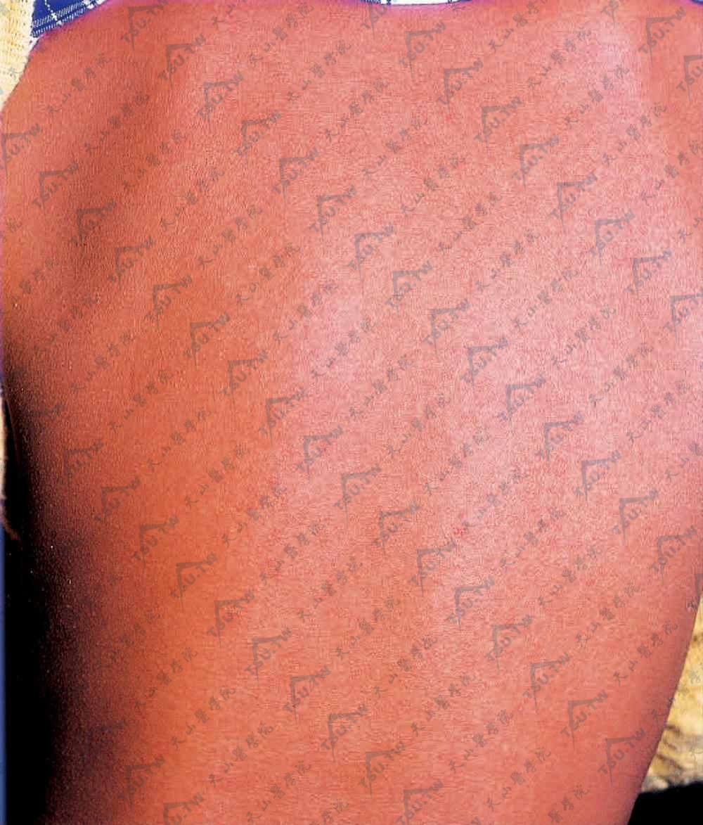 猩红热症状图片：全身弥漫性细小密集的红斑