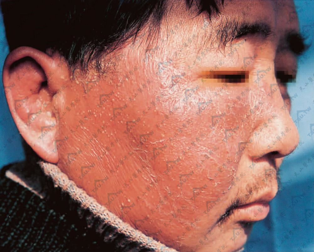 丹毒症状图片：面部右侧至耳壳部红斑肿胀