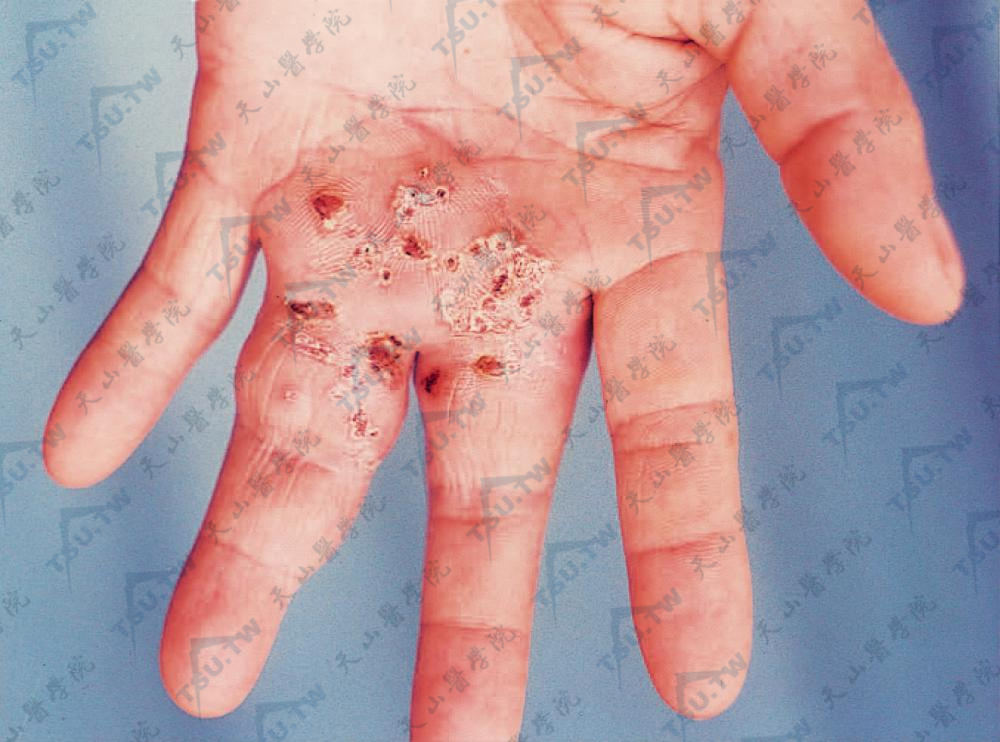 葡萄状菌病，左手掌至第三、四指根部多发性脓肿，形成多个瘘道，大部分结痂，皮下触及结节，质地较硬