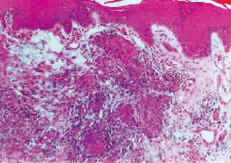 TT　真皮浅层上皮样细胞肉芽肿，周围有大量淋巴细胞包围（HE染色×100）