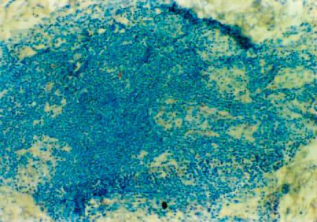 TT　病理切片示上皮样细胞肉芽肿内神经小支破坏-炎症灶内呈棕色条状部分（S-100蛋白染色×100）