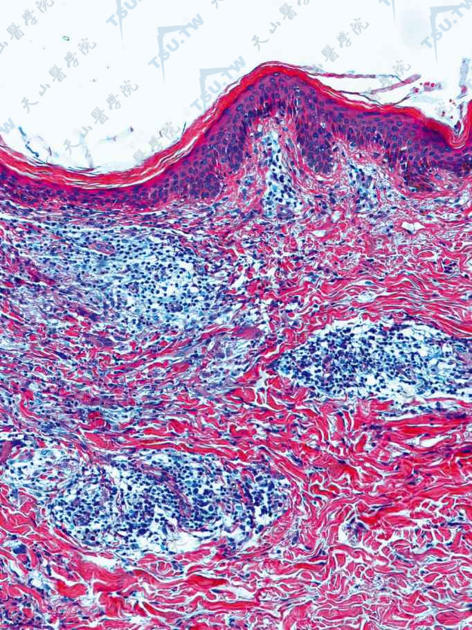 BT　表皮下见狭窄无浸润带，真皮内见上皮样细胞肉芽肿，周围有稀疏淋巴细胞包围（HE染色×100）