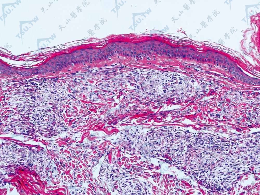 BL　表皮下见有无浸润带，真皮内见局限性组织细胞、泡沫细胞肉芽肿，炎症灶内有散在淋巴细胞（HE染色×100）