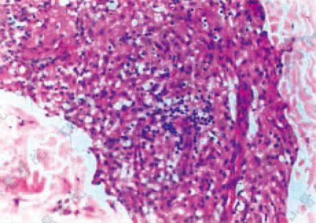 BL　真皮内见巨噬细胞肉芽肿，局部有淋巴细胞积聚（HE染色×400）
