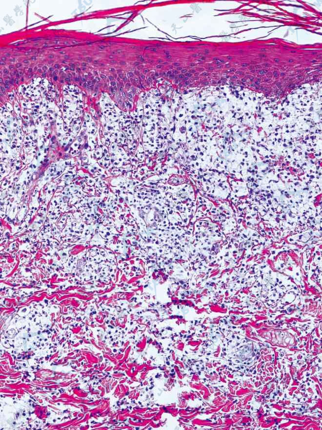 LL　真皮内见广泛泡沫细胞肉芽肿，炎细胞弥漫，淋巴细胞缺如（HE染色×100）