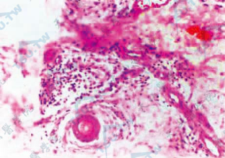 　I　毛囊、神经及血管周围呈非特异性慢性炎细胞浸润（HE染色×200）