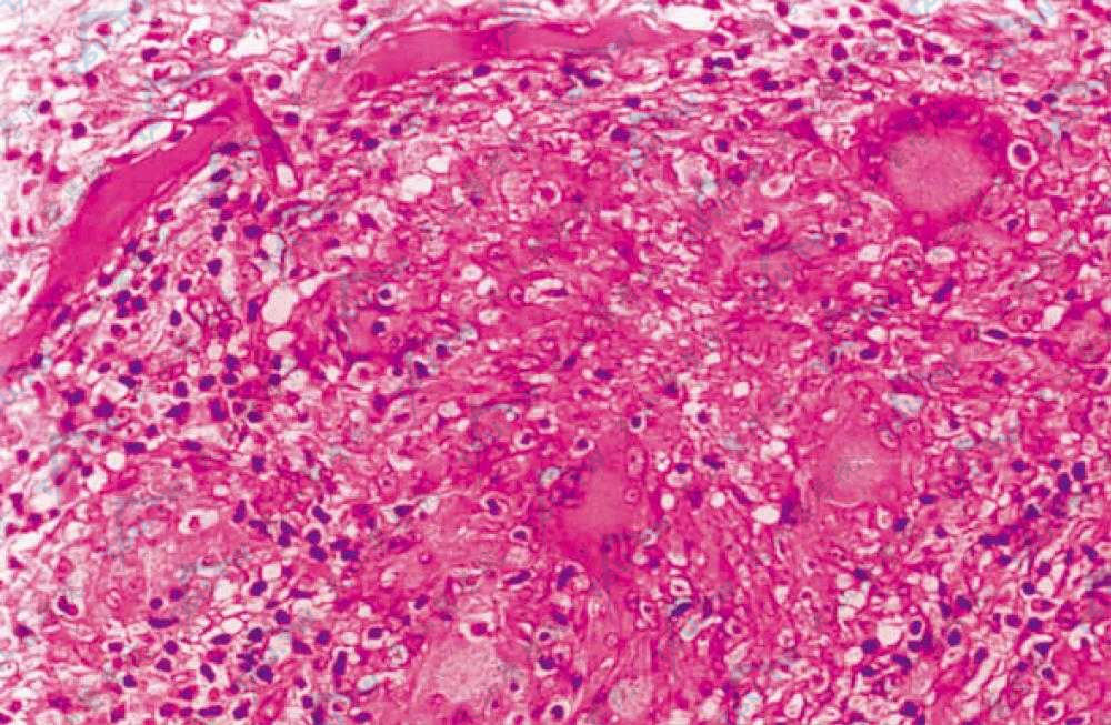 上皮样细胞组成的结节，边缘见郎罕巨细胞，周围少量淋巴细胞（HE染色×200）