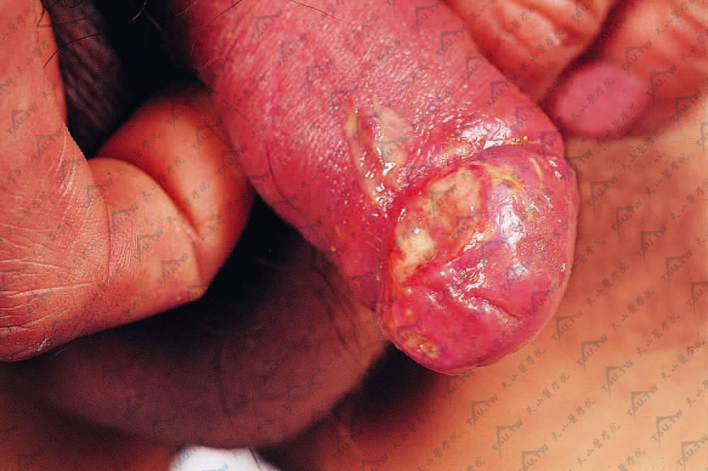 龟头或包皮部坏死性丘疹，破溃后形成溃疡，愈合后留有萎缩性瘢痕