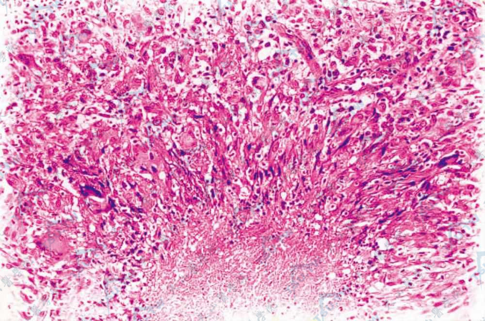 颜面粟粒性狼疮（Lupus Miliaris Faciei）组织病理