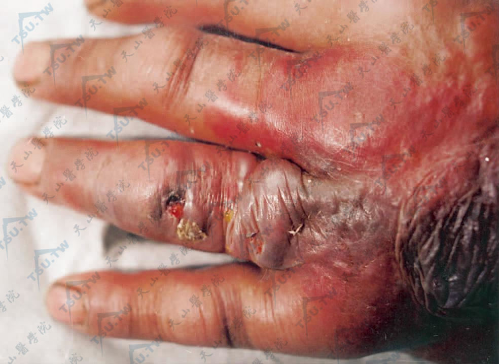 炭疽症状图：左手背部弥漫性红肿，中央皮肤松弛、呈紫色，无名指伸侧红肿，伴浅表溃疡及血性液体渗出