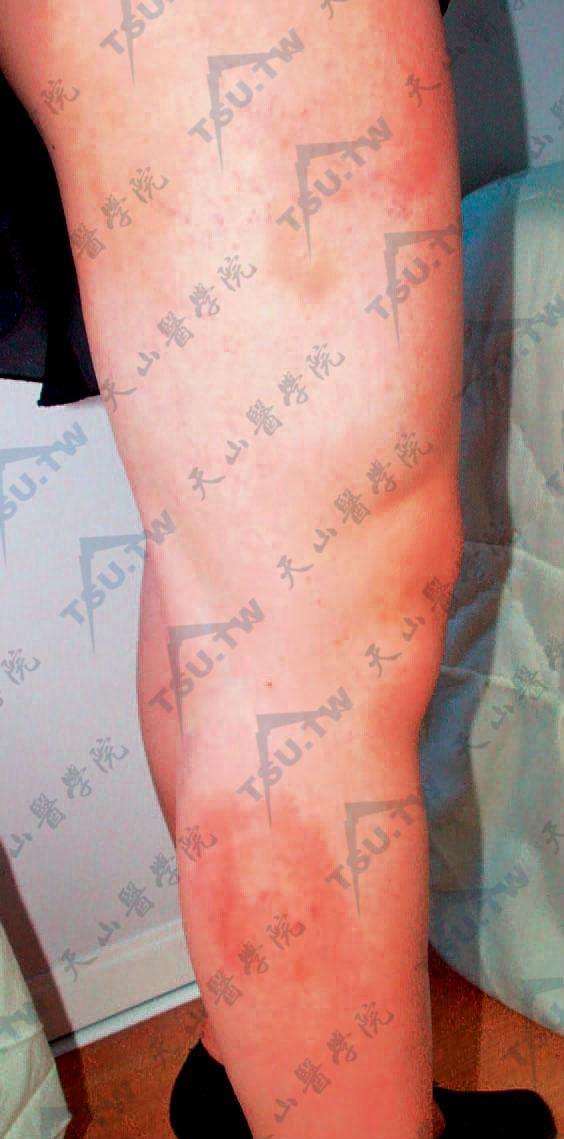 莱姆病症状图片：右大腿及小腿均有圆形环状红斑，中央消退。小腿部红斑可见同心双环状表