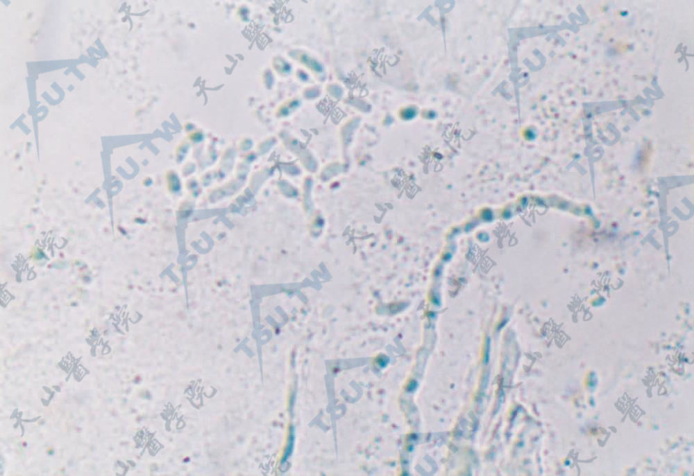 K0H溶液真菌直接镜检见大量的孢子和菌丝