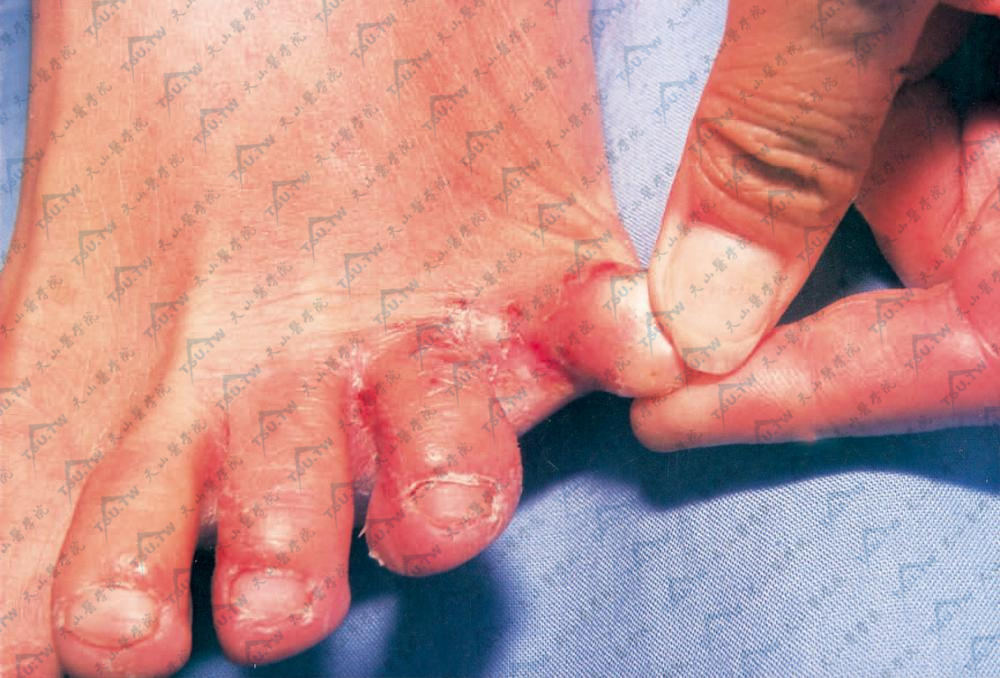 脚气：足趾间及趾周米粒大丘疹、水疱、小片状脱屑，呈环状附于皮损边缘