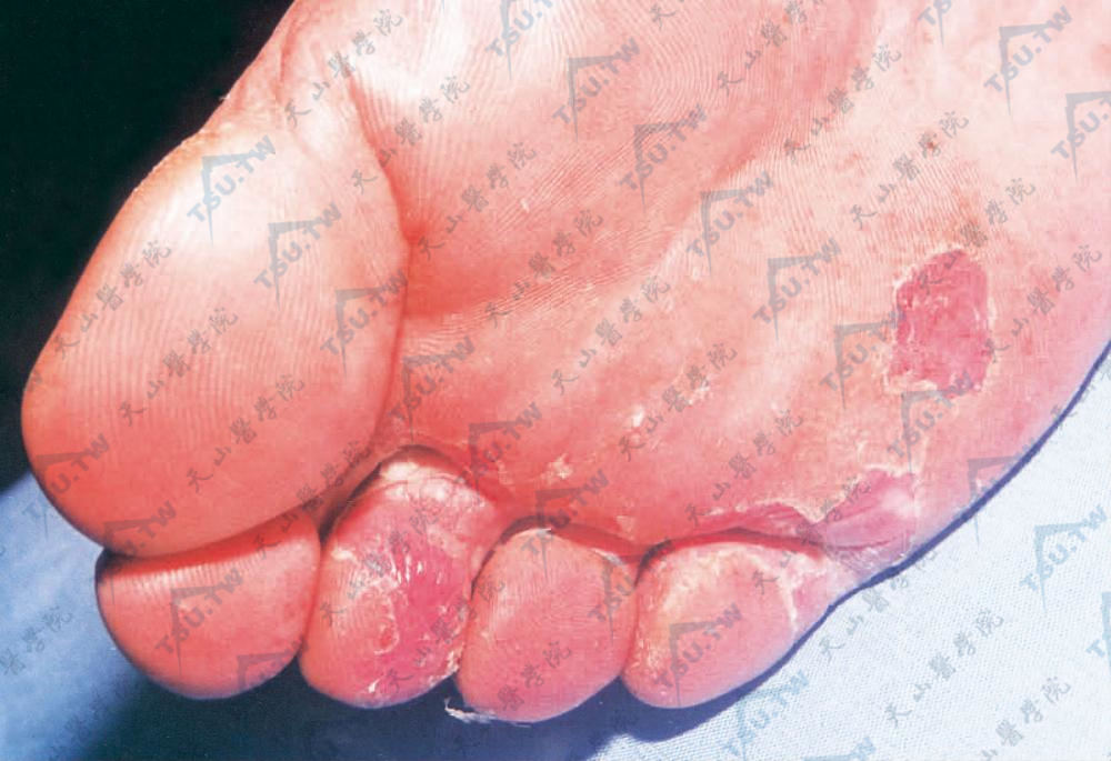 足趾间、趾端及跖部，境界清楚红斑，片状脱屑附于皮损边缘，红斑上有小水疱