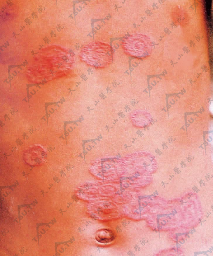 体癣：躯干部多数圆形及环状损害，边缘有红色小丘疹、丘疱疹及小片状鳞屑。边缘隆起，炎症明显