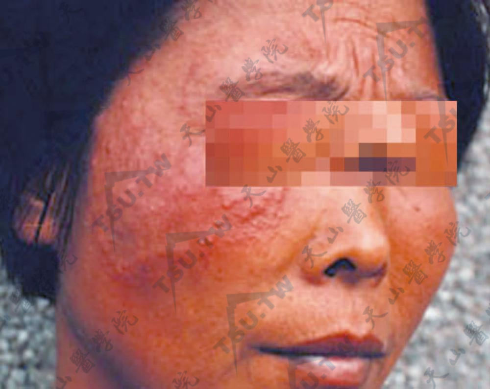 皮肤癣：面部大片红斑，丘疹、丘疱疹鳞屑少，无中心消退特征