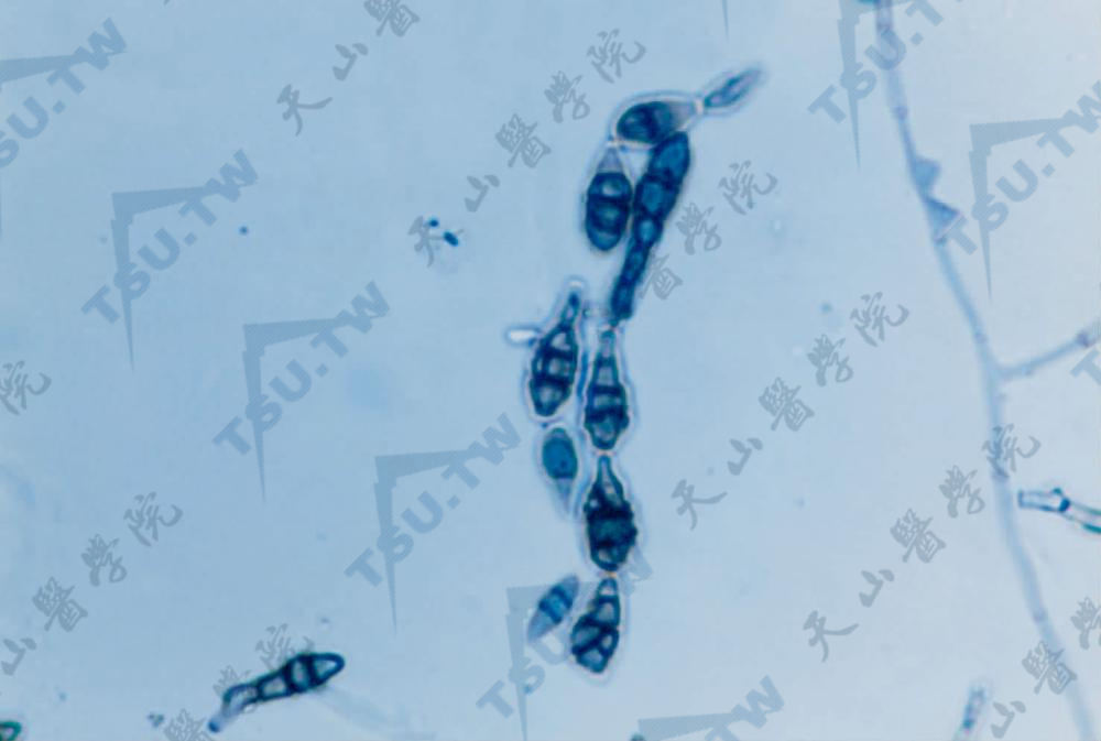 角膜表面分泌物KOH镜检可见分格菌丝（中国医学科学院皮肢病研究所　刘维达提供）