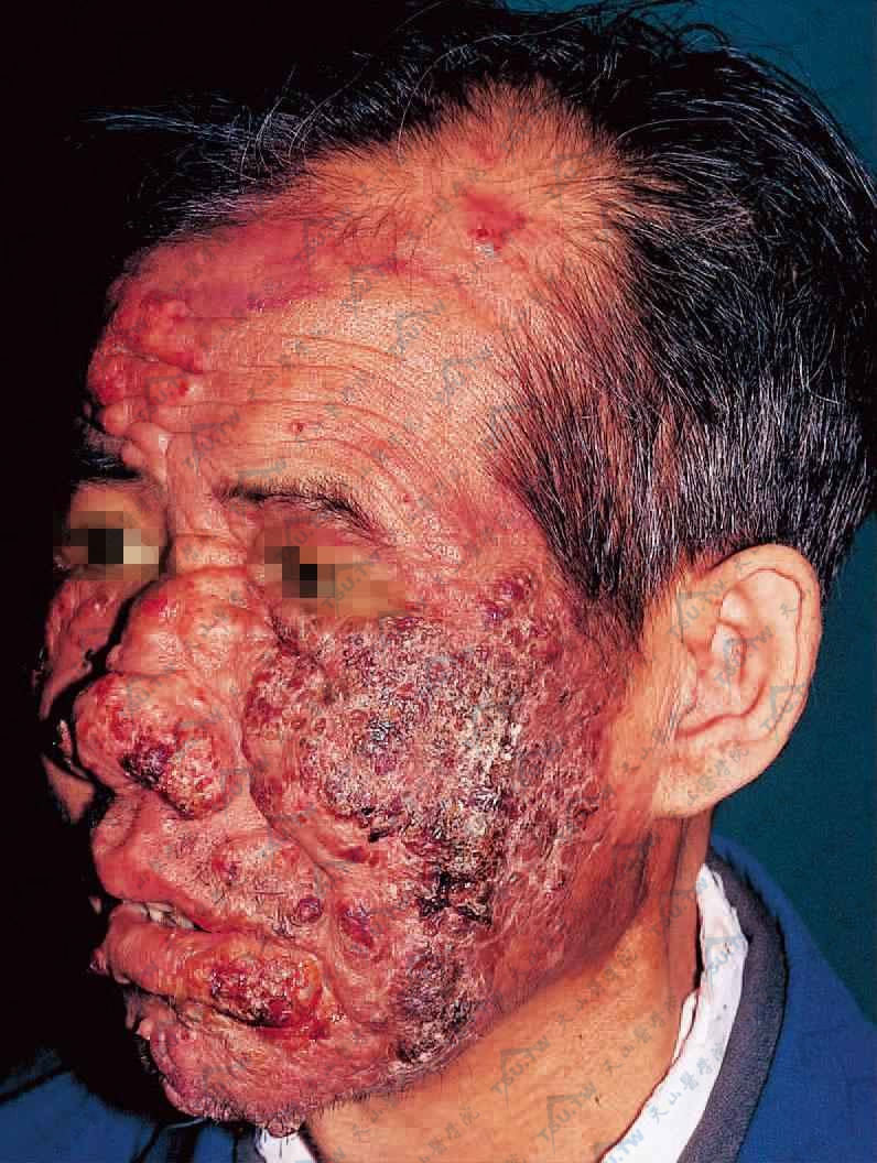 隐球菌感染引起的面部病变