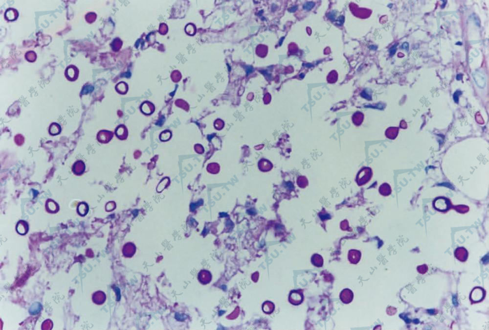隐球菌病　PAS染色见粘多糖荚膜（PAS染色×400）