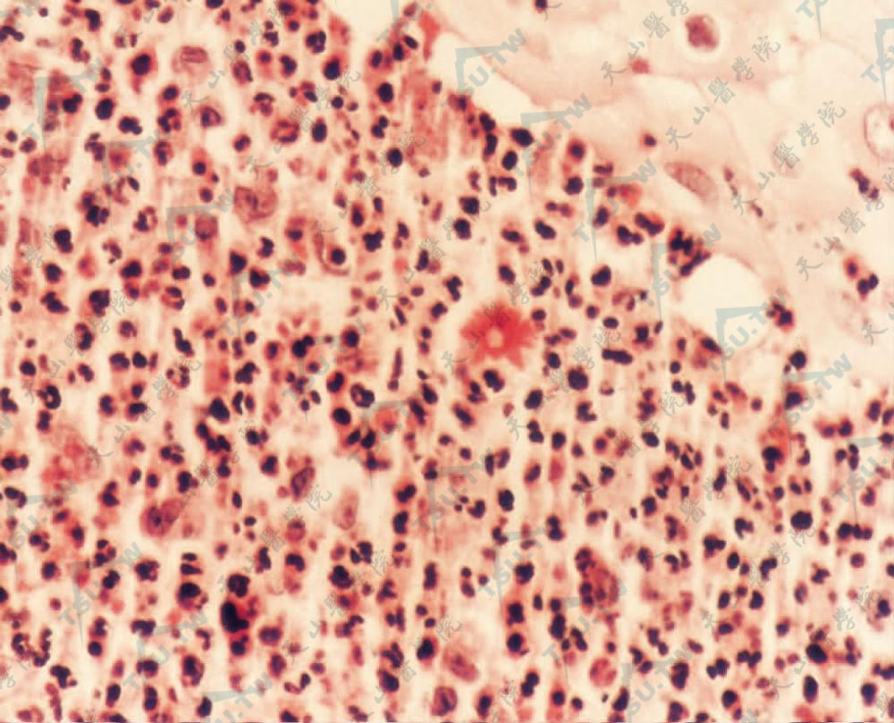 孢子丝菌病（星状小体）　中性粒细胞浸润内见星状小体（HE染色×400）