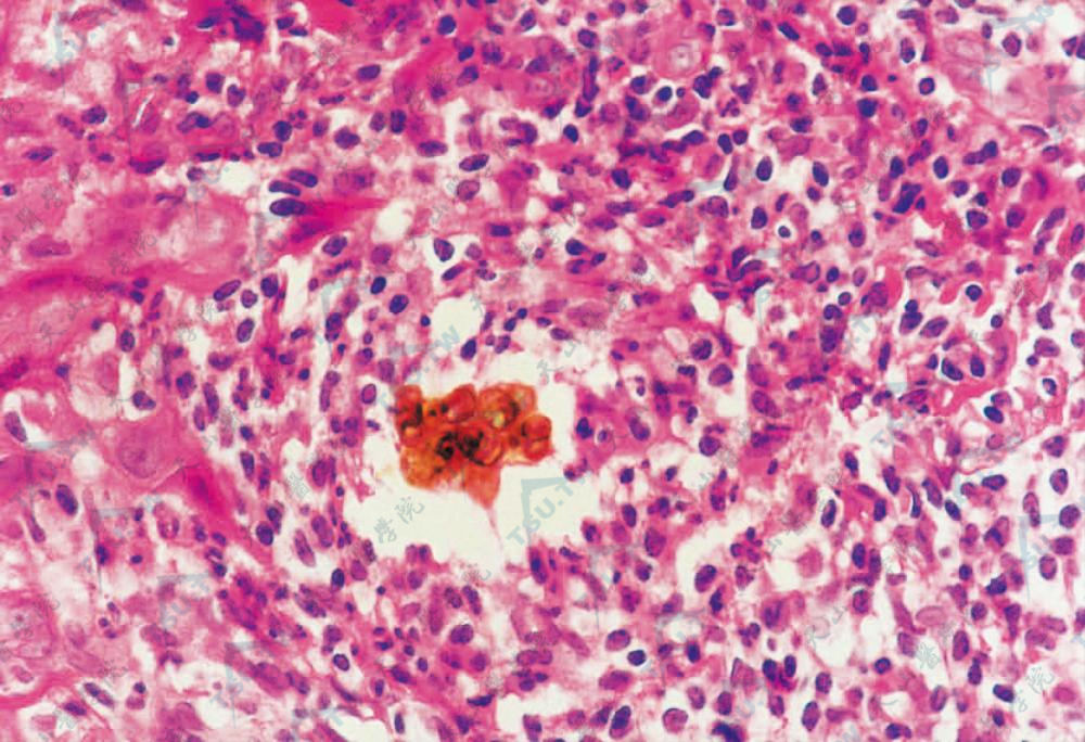 广泛炎细胞浸润，内有多数棕色厚壁孢子，圆形或卵圆形（HE染色×200）