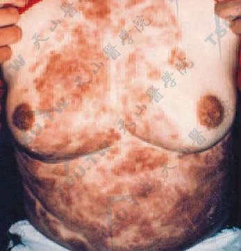 暗色丝孢霉病　胸腹部成片褐色斑块有浸润（编写者提供）