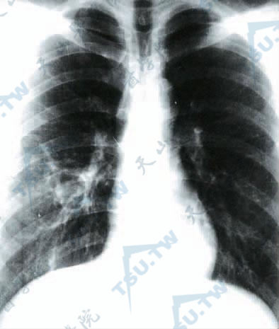 曲霉病　肺X线摄片见右上、下肺叶浸润（编写者提供