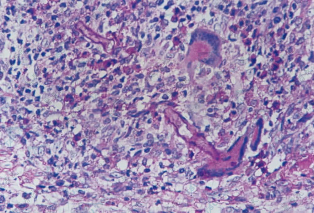 原发性皮肤毛霉病（b）　不分隔肉芽肿炎性反应组织内见巨细胞及粗宽直角分枝菌丝（HE染色×200）