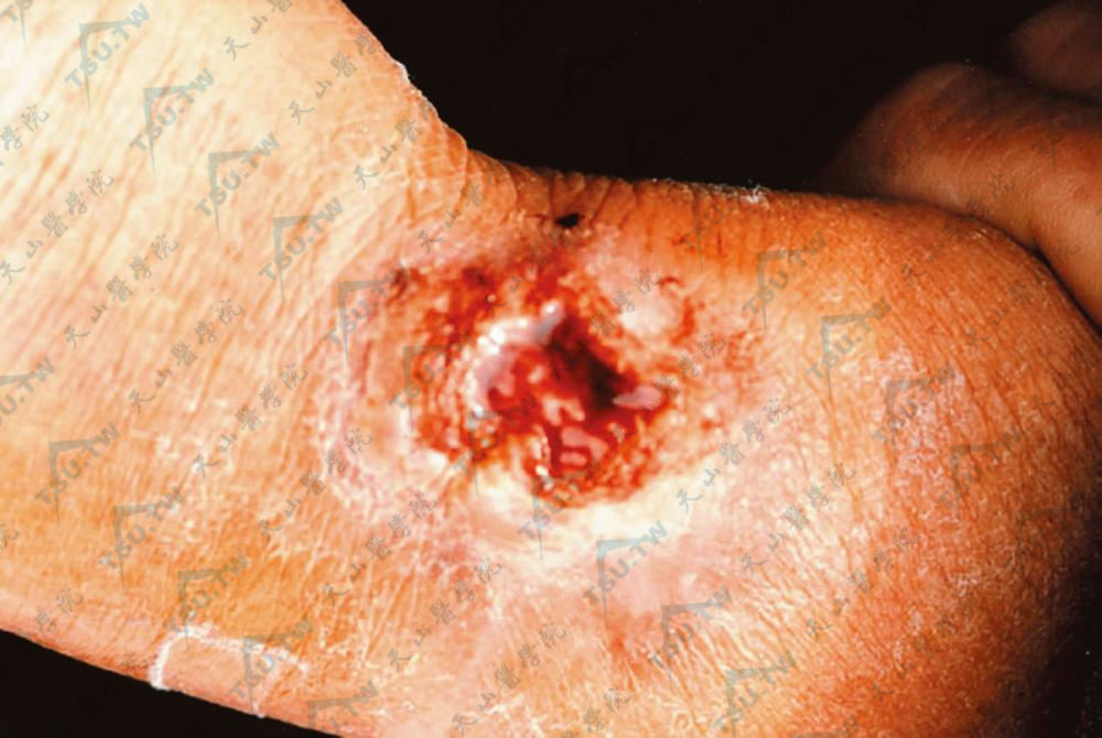 拟青霉病：手腕部浸润斑块、溃疡、肉芽增生（编写者提供）