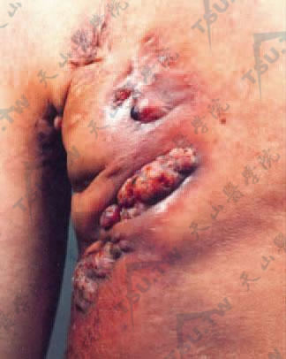 放线菌感染症状：胸壁多发肉芽肿及痿管