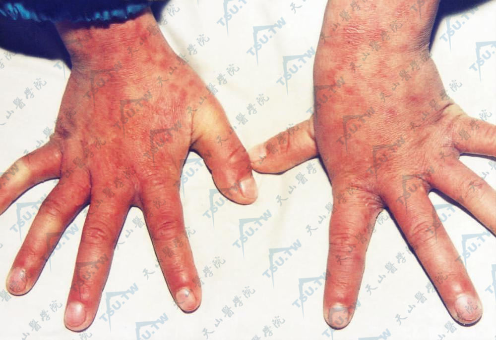 疥疮：指缝多处针头大丘疹、丘疱疹或水疱，由于搔抓致继发感染，有脓疱及黄痂