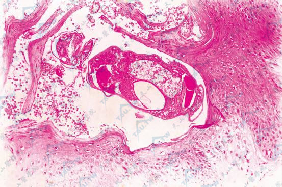 角层下疥虫虫体（HE染色×100）