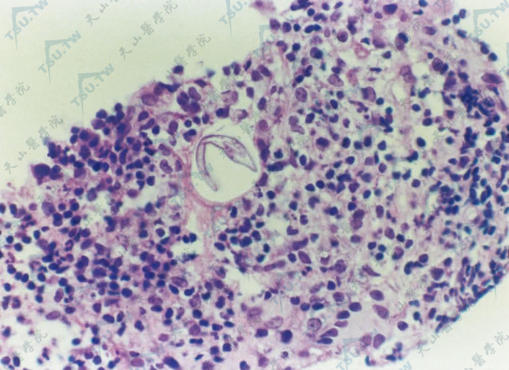 蠕形螨病组织病理　肉芽肿组织病理中见蠕形螨虫体