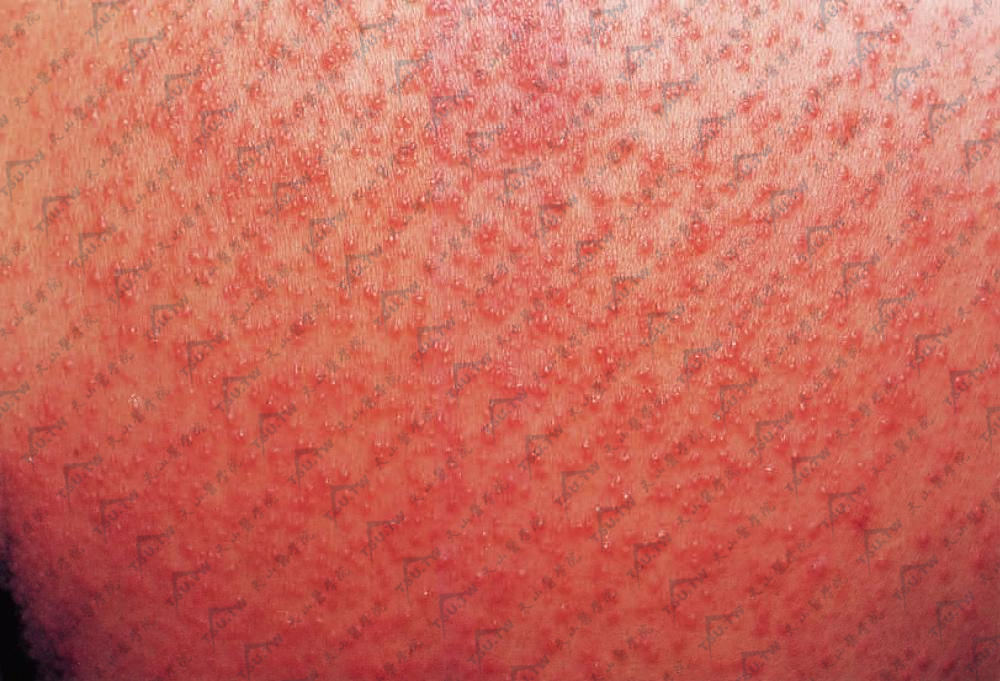 痱子症状图片：皮疹为圆形针头大小的白色、红色丘疹或丘疱疹，密集分布，有轻度红晕