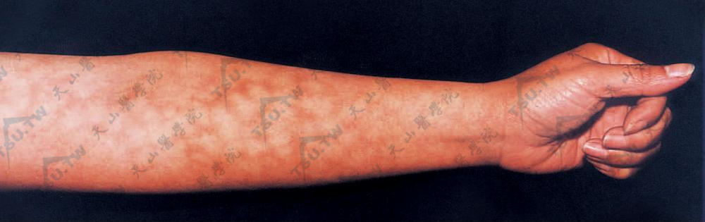 火激红斑症状：手臂部网状红斑及色素沉着